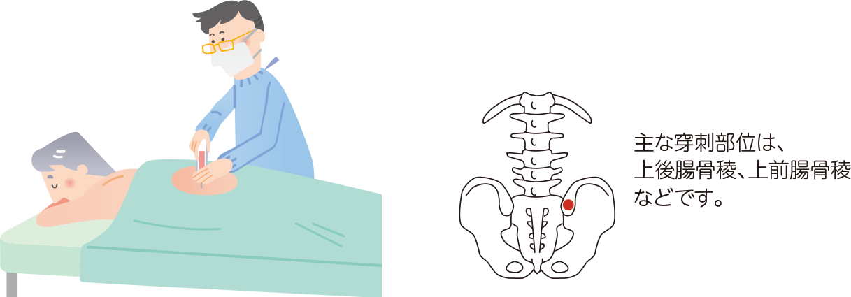 主な穿刺部位は、上後腸骨稜、上前腸骨稜などです。