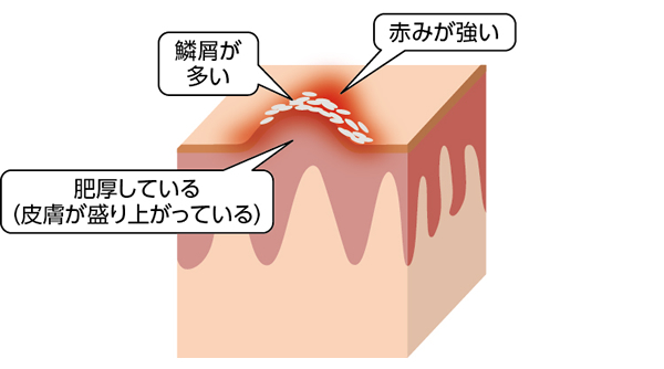 鱗屑があり、赤い肥厚がある状態