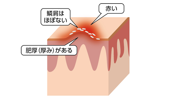 鱗屑はほぼないが、赤い肥厚がある状態