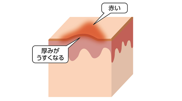 赤い肥厚が少しある状態