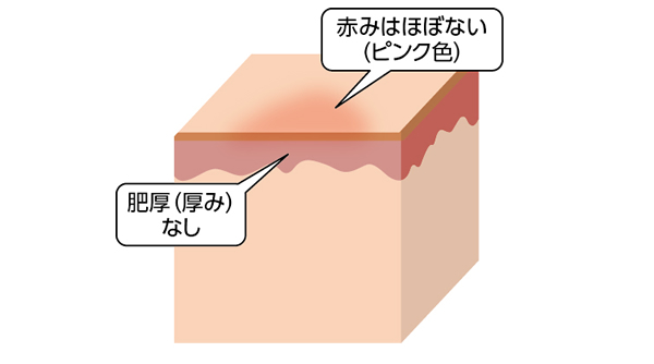 うすい赤みのみがある状態