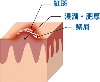 乾癬の症状イメージ