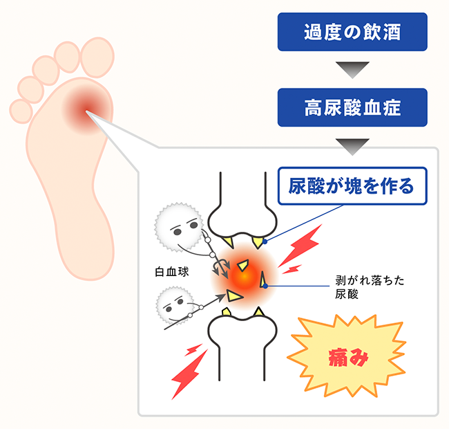 飲酒による高尿酸血症・痛風