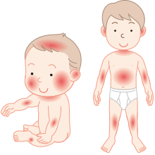 アトピー性皮膚炎：症状が出る部位（[乳児期]頭や顔、首 [幼児期・学童期]関節屈曲部位、全身）