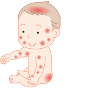 乳児湿疹：症状が出る部位（全身、特に頭、顔、わきの下 、外陰部、おしり）
