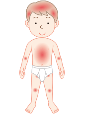 乾癬：症状が出る部位（全身、特に肘（ひじ）、膝頭（ひざかしら）、頭部、腰、臀部）