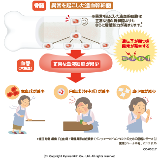 異常を起こした造血幹細胞 ※異常を起こした造血幹細胞は正常な造血幹細胞よりもさらに増殖能力が高まります。 遺伝子が傷つき異常が発生する 正常な血液細胞が減少→赤血球が減少、白血球が減少、血小板が減少 出典：直江知樹 編集『白血病/骨髄異形成症候群(インフォームドコンセントのための図説シリーズ)』 医薬ジャーナル社,2013,p.15