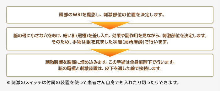 DBSの手術法