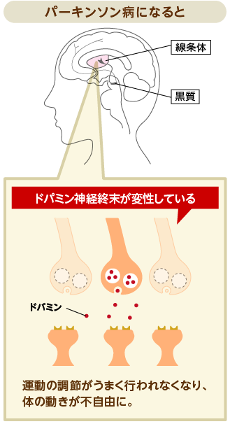 パーキンソン病になると